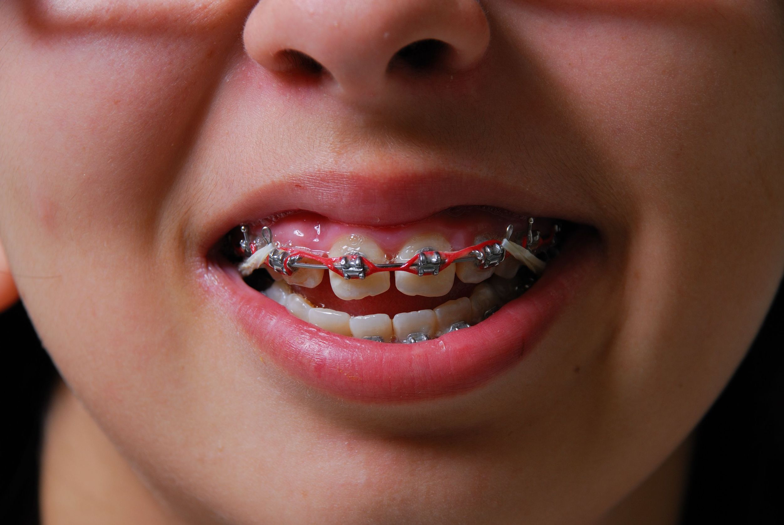Invisalign For Adults In Strongsville OH Is A Great Way To Straighten Your Teeth Comfortably
