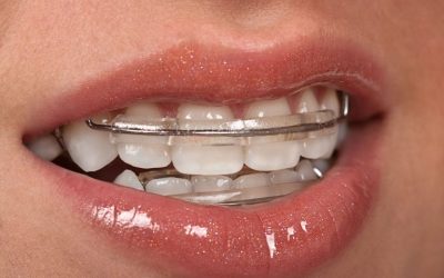 Say Goodbye To Misaligned Teeth With Braces In Strongsville, OH