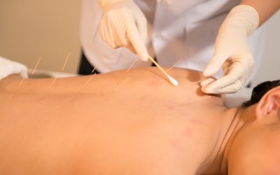 Acupuncture vs. Medication: Exploring Non-Drug Pain Relief Alternatives