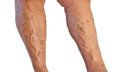 Protect Your Health: What Schaumburg Patients Need to Know About Blood Clot Risks