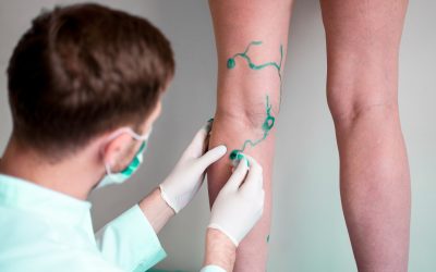 Relief From Leg Pain Starts With Varicose Vein Treatment In Brooklyn NY Residents Trust