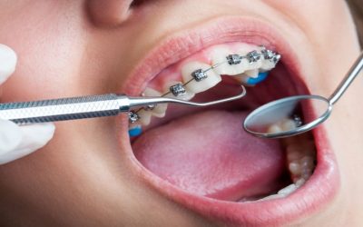 Achieve Discreet Orthodontic Success Using Invisalign Fort Lauderdale FL for Adults and Teens
