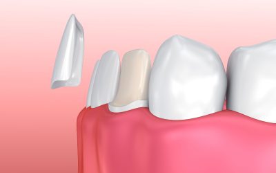 Enjoy a Brighter Smile Using Porcelain Veneers in Isle Of Palms Sc for Stunning Appeal